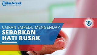 Atresia Bilier, Kondisi di Mana Cairan Empedu Tidak Dapat Menuju Usus dan Menimbulkan Kerusakan Hati