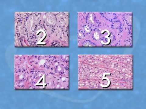Erste-Hilfe-Prostatitis Kürbiskerne für Prostata-Forum