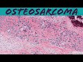 Osteosarcoma 101 Bone Pathology Basics