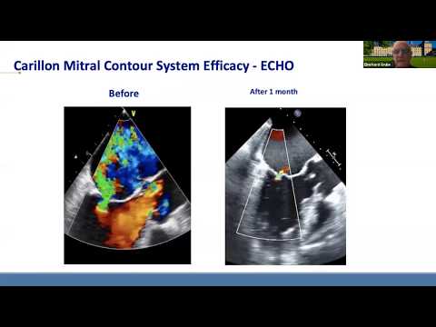 Present and Future of Transcatheter Mitral Intervention - Eberhard Grube