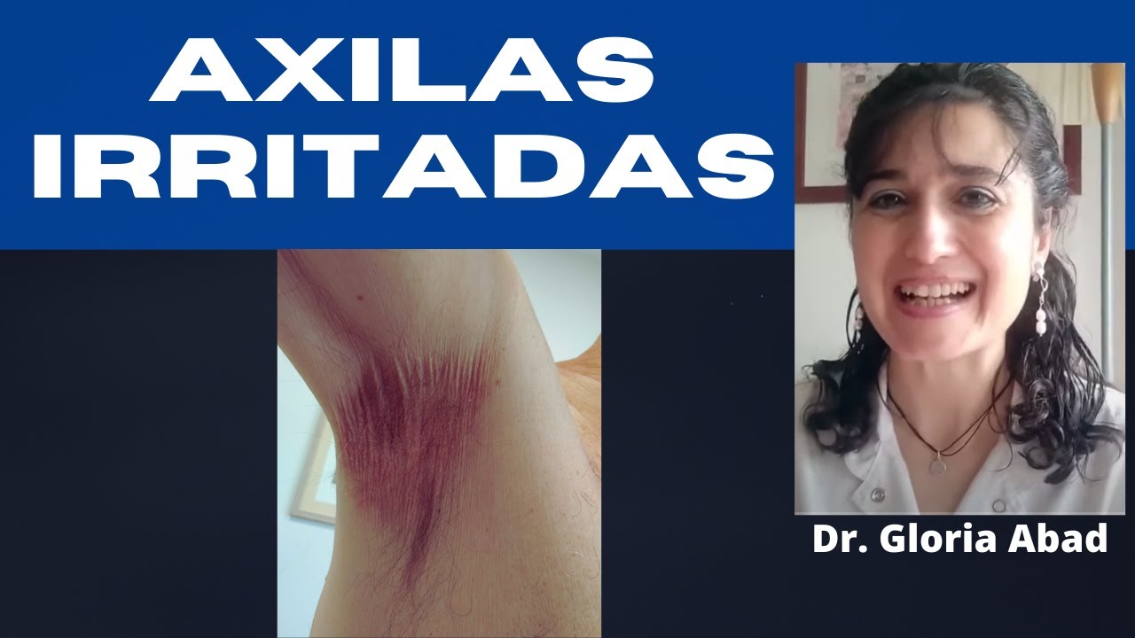 AXILAS IRRITADAS ¿HONGO O DERMATITIS ¡Me pica DEBAJO DEL BRAZO, CÓMO SOLUCIONARLO!