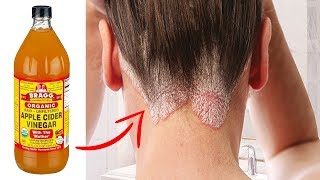 Get Rid Of Hair Fungus With 10 Simple Home Remedies