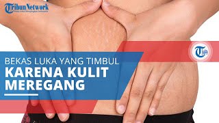 Selulit, Jenis Bekas Luka yang Berkembang ketika Kulit Kita Meregang atau Menyusut dengan Cepat