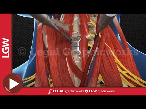 Cervical Fusion Surgery 3D animation C3-4 C5-6 C6-7
