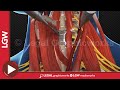 Cervical Fusion Surgery 3D animation C3-4 C5-6 C6-7