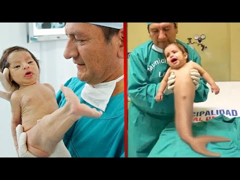 10 ENFANTS NÉS AVEC UN PHYSIQUE HORS DU COMMUN ! | Nalak
