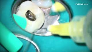 POV clinical vid of tooth 14 from start to finish. No cbct. Go to flexivodental.com @FlexivoDental 