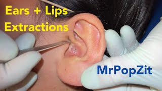 Acne Extractions! Large Blackheads and whiteheads in the ears and on the lips. MrPopZit