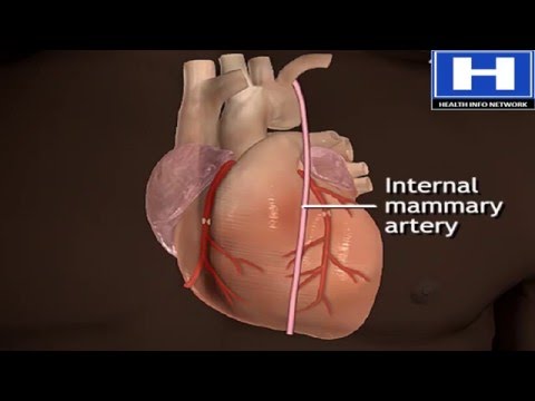 How Does Heart Bypass Surgery Work | Coronary Artery Bypass Graft Procedure Animation | CABG Video