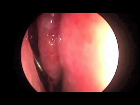 Maxillary Sinus Drainage Under Local Anesthesia
