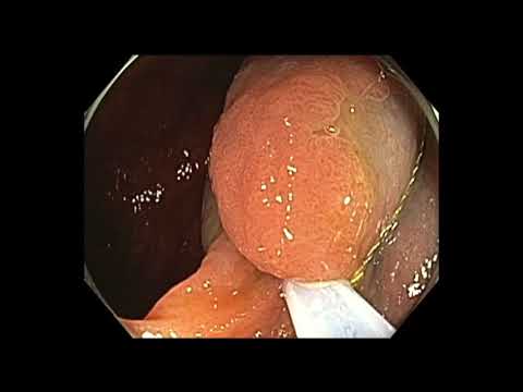 Colonoscopia: resección endoscópica de la mucosa de intestino ciego