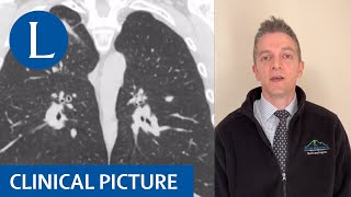 Clinical picture: Digging into coal workers pneumoconiosis