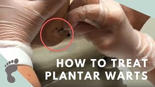 How To Treat Plantar Warts