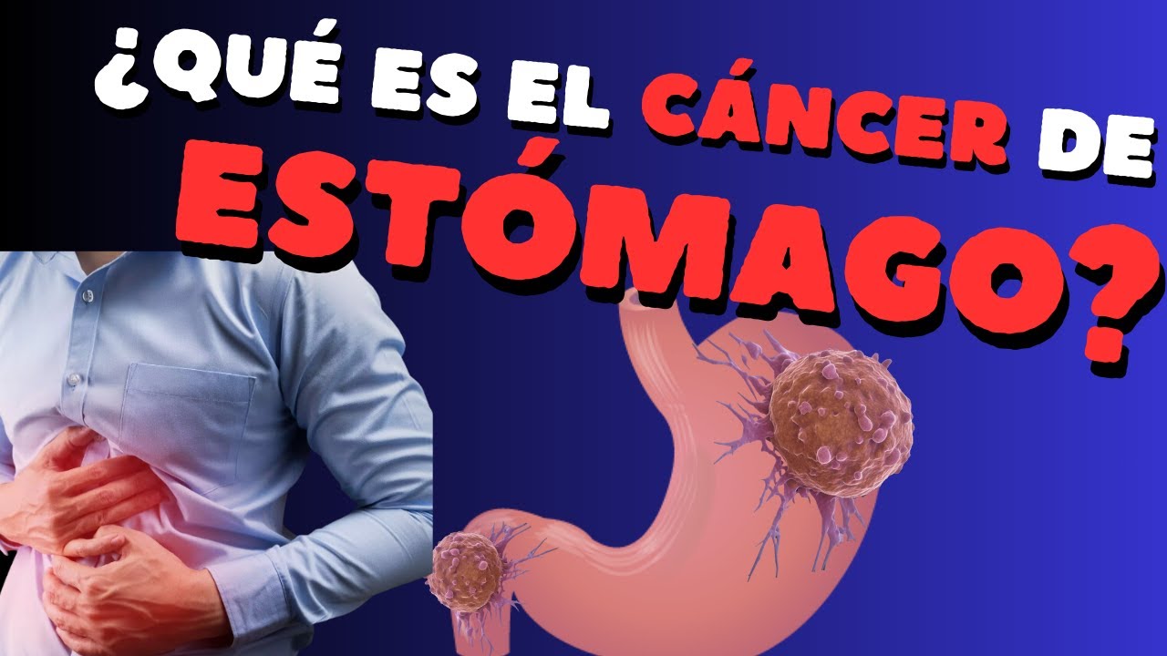 ¿Qué es el cáncer de estómago?