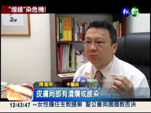 埋線超過20針 循環變慢難享"瘦"!