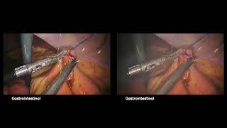 3D Video Laparoscopy System (Dr. Kim's Console) youtube video