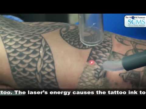Can permanent tattoos be removed? | Yahoo Answers