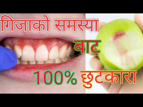 Gums Disease Symptoms & Treatment at home | Home remedies for bleeding gums | गिजाको समस्याको घरेलू.