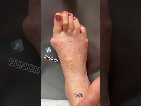 How to Transform a Huge Bunion with an AMI Bunion Procedure