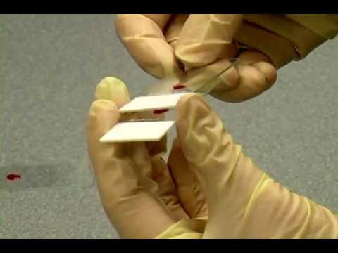 Bone Marrow Smear Preparation