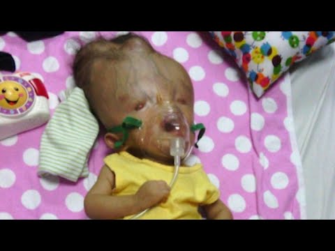 Toddler with Birth Defects 'Incompatible with Life' Defies Odds in Venezuela