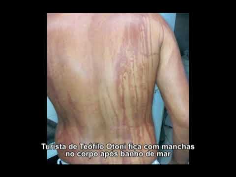 Turista de Teófilo Otoni fica com manchas no corpo após banho de mar no sul da Bahia