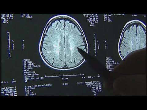 Study indicates COVID-19 causes brain damage, even in mild cases
