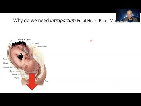 Physiological Interpretation of Cardiotocograph (CTG) : Paradigm Shift     Part 1