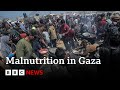 Malnutrition Rises In Gaza As Israeli Blockade Enters Third Month BBC News