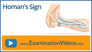 Homan's Sign