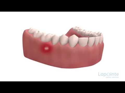 comment soigner ulcere dans la bouche