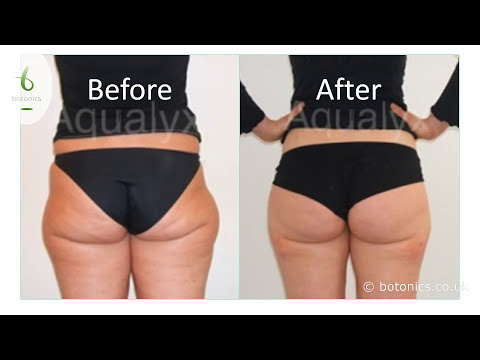 Aqualyx Fat Dissolving Injections