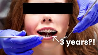 How LONG will you be in BRACES...the truth