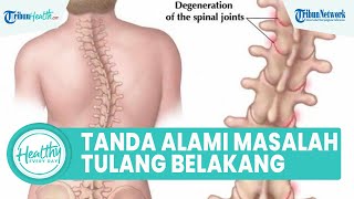 Kenali Tanda Seseorang Alami Gangguan Tulang Belakang, Satu di Antaranya Skoliosis