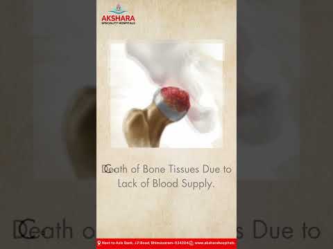Avascular Necrosis of the Hip: Symptoms, Causes, and Treatment Explained  I  Akshara Hospitals .