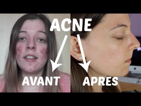comment soigner acne naturellement