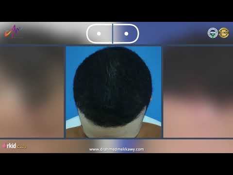 نتيجة مبهرة بعد 8 شهور من زراعة الشعر مع دكتور أحمد مكاوي استشاري جراحات التجميل