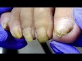 All are onychomycosis, very yellow and very long, professional pedicure【Doctor Liu Pedicure】