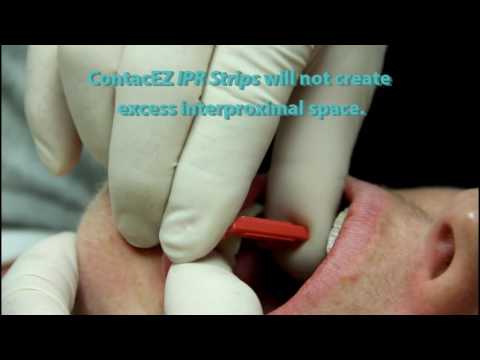 Using ContacEZ IPR Strips with Overlapping Teeth