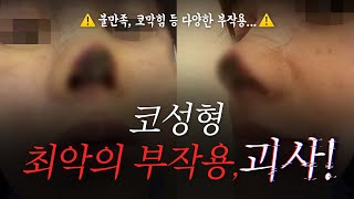최악은 구축, 차악의 코성형 부작용은?☠️