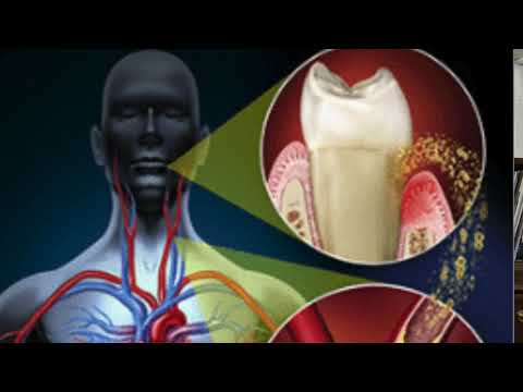 Bacteria in our mouth can cause damage to our body.