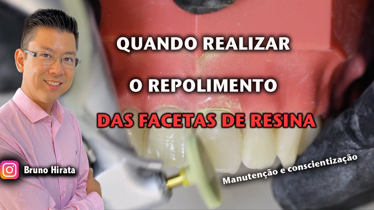 Quando preciso polir as facetas de novo?