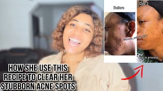 How she use this recipe to clear her stubborn acne and dark spots | quick action results