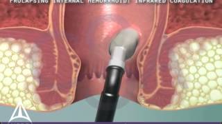 Infrared Coagulation Therapy for Hemorrhoids - 3D Medical Animation