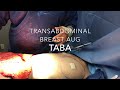 TABA- Trans Abdominal Breast Augmentation- Dr. Kevin Tehrani