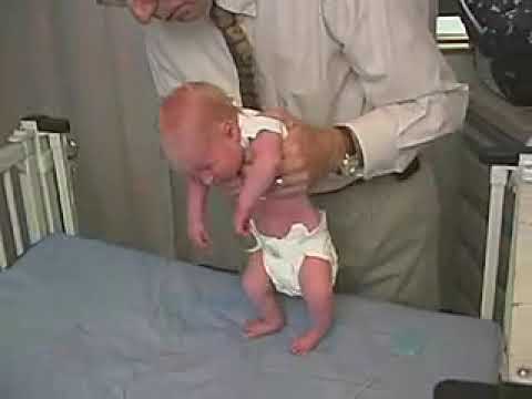4.25 - Primitive Reflexes, Stepping - Newborn Abnormal - Infant Clinical Examination(MRCP)