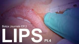 FREE LIP INJECTIONS! | Botox Journals - Ep 3 | Pt.4