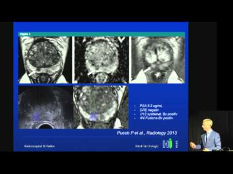 Prostatakarzinomsymposium : Neue Methoden der Bildgebung