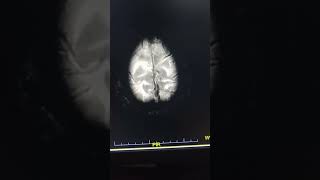LEFT PUTAMEN HEMORRHAGE WITH PERIFOCAL EDEMA BRAIN