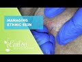 Managing Ethnic Skin Extractions Part 2